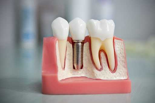 С чего начать протезирование зубов